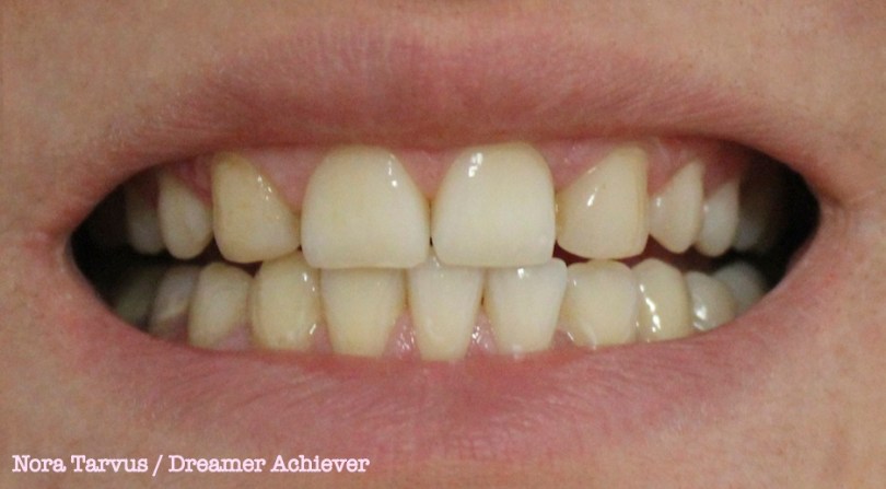 TeethAfter10days kopio